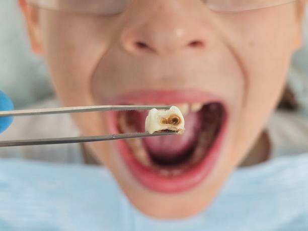 Best Broken or Cracked Tooth Emergency Dentist in Wfield, IN