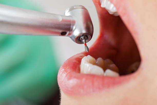 Best Broken or Cracked Tooth Emergency Dentist in Wfield, IN
